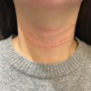 이상의원 | 목주름 시술 잘하는곳 이노벨의원 내돈내산 솔직후기(트리필프로, 바이리즌)