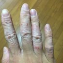 번짐 | (실사 후기) 접촉성피부염 번짐 원인과 전성분으로 해결