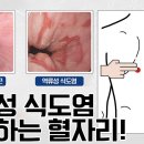 끔찍한 통증 '역류성 식도염'! 누를수록 좋아지는 혈자리! | 나는 몸신이다 이미지