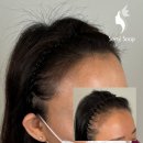 선헤어라인 이미지