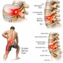 달리짐(DALLI GYM) | [양정헬스 | 양정PT] 요추 5,6번 디스크 관리방법은?