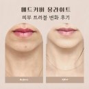 몽메드 | 메드커버 몽라이트 솔직후기 식이섬유와 비타민C로 피부 트러블 여드름 비포 에프터