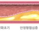 심혈관 질환 및 심근경색 증상과 원인 이미지