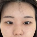 언주역 애교살 | 고민 해결하고 온 하우뷰티 리얼 후기