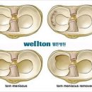 관절내시경 수술의 정확한 진단과 치료 이미지