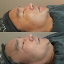 NR-24[마령로]-상-303 | 배곧 피부관리 나름답다 /보톡셀리프팅 3회 관리 후기사진