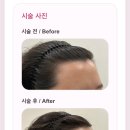 온세디자인 | 대전 갈마동 헤어라인 문신 반영구 맛집 온세뷰티 후기!