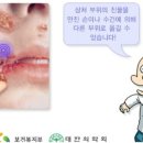 농가진의 증상과 치료 이미지