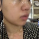 서울한의원 | [서울/양천구 신정동] 세연한의원 CO2 레이저 편평사마귀 제거 후기 | 내돈내산
