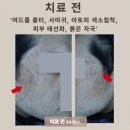 한티역 여드름 피부과, 여드름 흉터 및 복합적 피부질환 치료 후기! 20대 남성 여드름