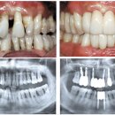 치주질환 임플란트 수술 이미지