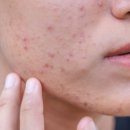 리체한방병원 | 마포구한방피부과 여드름 흉터 치료 병원 찾는 꿀팁 공개