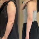 라인@ | 신도림 팔 뒷볼록 빼는법｜여름 전 팔뚝라인 정리 후기