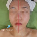 박소영한의원 | 일산 덕이동 탄현 뷰티샵 라베누스 바이오포톤 리프팅 고주파