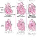 심부전(HF)(울혈성 심부전)-심장 및 혈관 장애 이미지