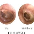 침삼킬때 귀아픔 소리 원인 7가지 대처 방법 이미지