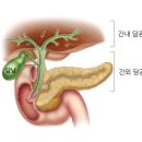 담관암, 담도암(Cholangiocarcinoma) 이미지