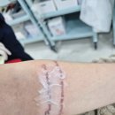 신사루체약국 | 강남문신제거 피코슈어 2회차 레터링 문신제거 후기