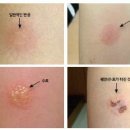 결핵 피부반응 검사[tuberculin skin test] 이미지