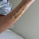 유상호한의원 | 척골충돌증후군 TFCC인대 손상 수술 후기(2) 독산동 새움병원 정우성원장님 수술