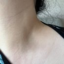 온결에스테틱 | 서산피부샵추천 더온결에스테틱 쥐젖제거 내돈내산 후기