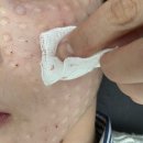 양이멍이 | 대구 스킨부스터 [리쥬란HB] 경과까지 내돈내산 솔직후기 : 상세사진