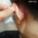 상동경희한의원 | 상동지루성피부두피염 치료 사례, 10년간의 고통에서 벗어나기까지!