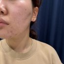 달비아뷰티 | 달비아뷰티 여드름 관리 솔직후기, 중랑구 피부관리샵 추천