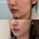 클레어성형외과의원 | [칼럼]무너진 턱선, 티타늄리프팅으로 복구한 후기