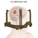 시신경 뇌수막종 방사선치료? 수술? 아산병원 사이버나이프 진행 과정 정리