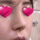 그날성형외과의원 | 그날성형외과 후기, 매부리코에 대해서