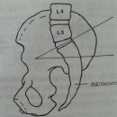 요천추각 lumbosacral angle 이미지