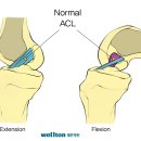 십자인대파열, 십자인대수술, 전방십자인대, 무릎관절내시경 이미지