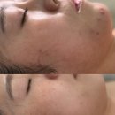 [포항 피부관리] 유강 피부관리실에서 찾은 성인 여드름흉터관리의 해답, 슈퍼젝션전문점 리얼 후기!