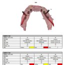 큰숲L디지털치과기공소 | 관저동치과추천? 00000임플란트, 오차를 최소화합니다