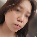 달한조각 | [안양성형외과] 경기도권에서 제일 큰 성형외과 가서 코 조각주사 받고 온 후기 2(feat.한달 경과 후기)