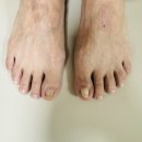 연세고든병원 | 의정부 발톱무좀 내성발톱 무좀병원에서 세심한 케어