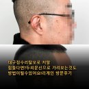 리게인 | 두피문신으로 가려보는것도 방법이될수있어요!리게인 방문후기 두피문신의 시작과 정수리 밀도 보강