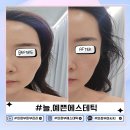 의정부경전철 회룡역 | 의정부피부관리 늘,예쁜에스테틱에서 V브이라인 윤곽 케어받고 달라진 얼굴 라인 비포&amp;애프터 후기