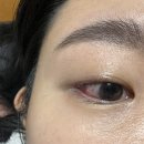 박리 | [아직 어리신데..] 부산에서 망막박리수술, 백내장수술까지 하고 온 후기