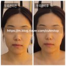 더블유스칼프 | 사우동피부관리 더블유에스테틱 두피관리로 탄력찾고 동안된 얼굴라인