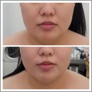 아름다운스킨케어 | 이대입구 피부관리 어디갈지 고민이라면? 블레싱스킨케어 선택 후기