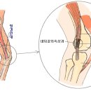 무릎통증(장경인대염) 이미지