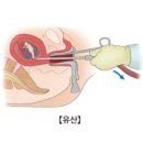 여성질환 계류 유산(Missed abortion)이란? 이미지