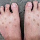 남성반점 이미지