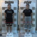 평택-평택-23 | 평택 체형교정 후기 / 굽은등 비포에프터