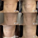 동탄소프트 | 수원 망포 피부과 벨로테로 목주름필러 내돈내산 후기(1개월 비포애프터)