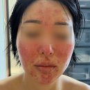 열매한의원 | 주사피부염 피부과 한의원 추천하는 곳 콕 짚어 말합니다.