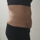 심정병원 | 수원 서울대원장 지방분해주사 전문 다이어트병원 6kg 감량 성공후기!