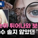 [리빙톡] "눈이 튀어나와 보여요" 가수 솔지 앓았던 '이 병' 이미지